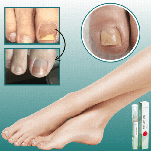 Zerofung™ Nagelreparationspenna