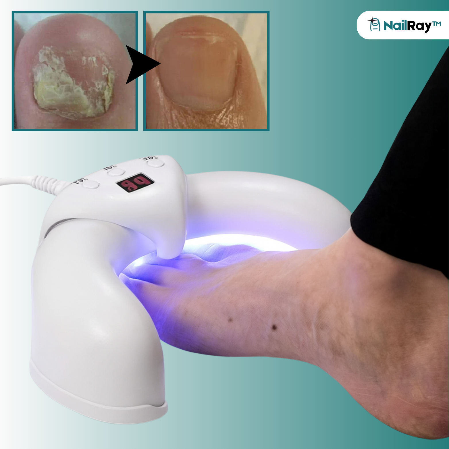 NailRay™ Laser Nagelbehandlingsenhet