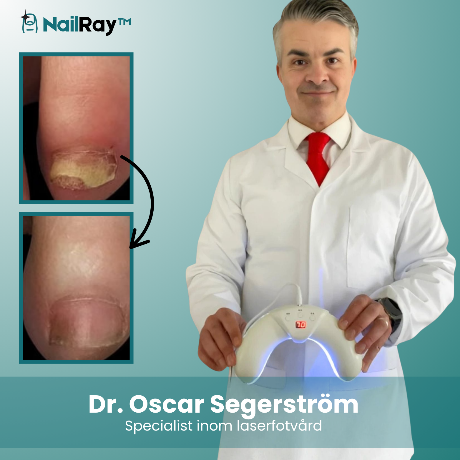 NailRay™ Laser Nagelbehandlingsenhet