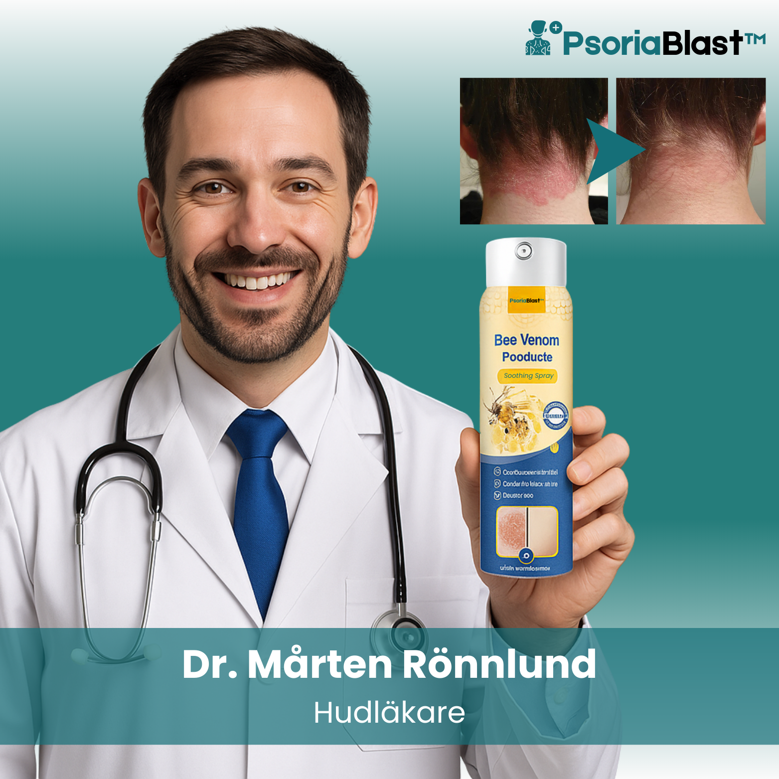 PsoriaBlast™ Bee Venom Psoriasis Spray