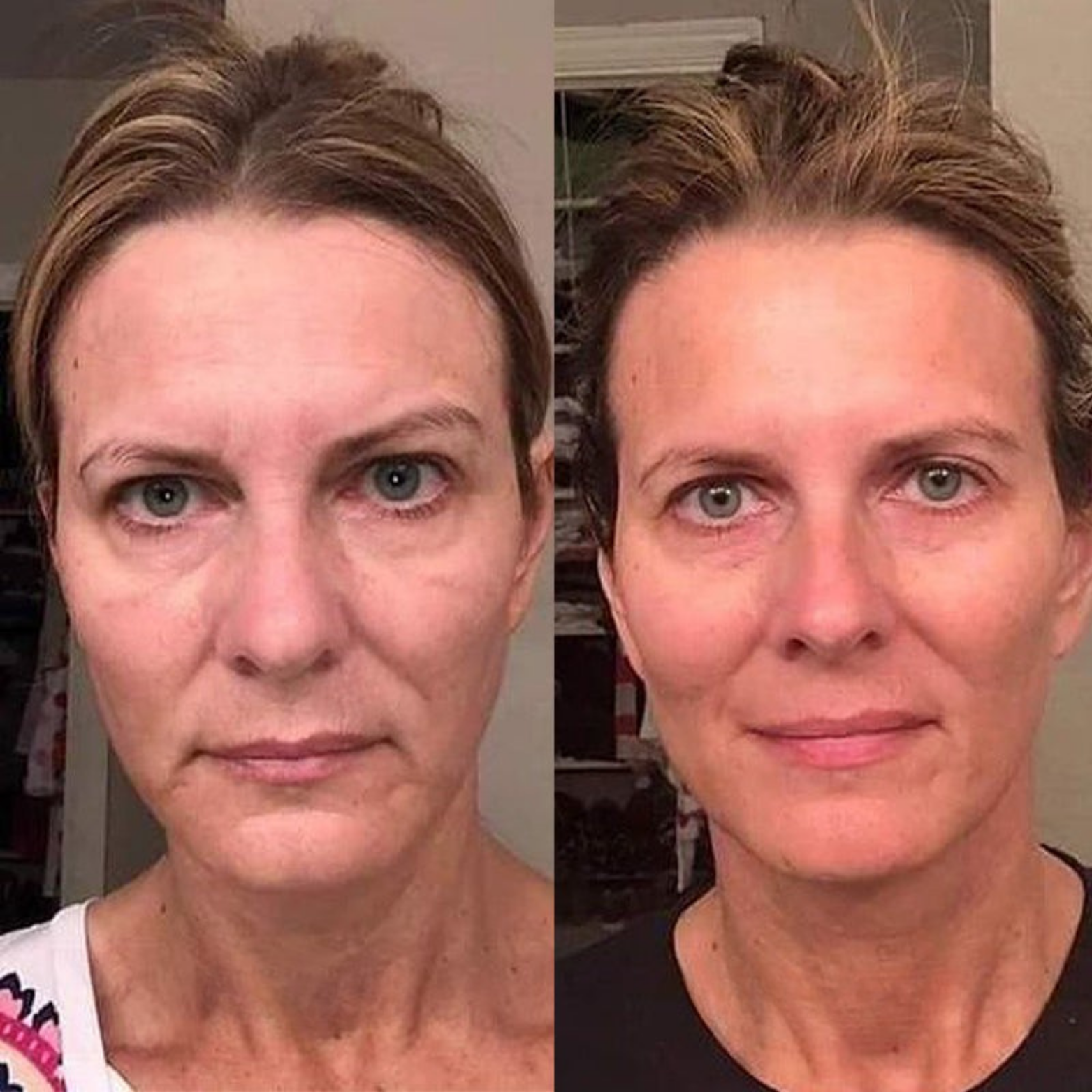 RevitaPen™ Mikroinfusionspenna