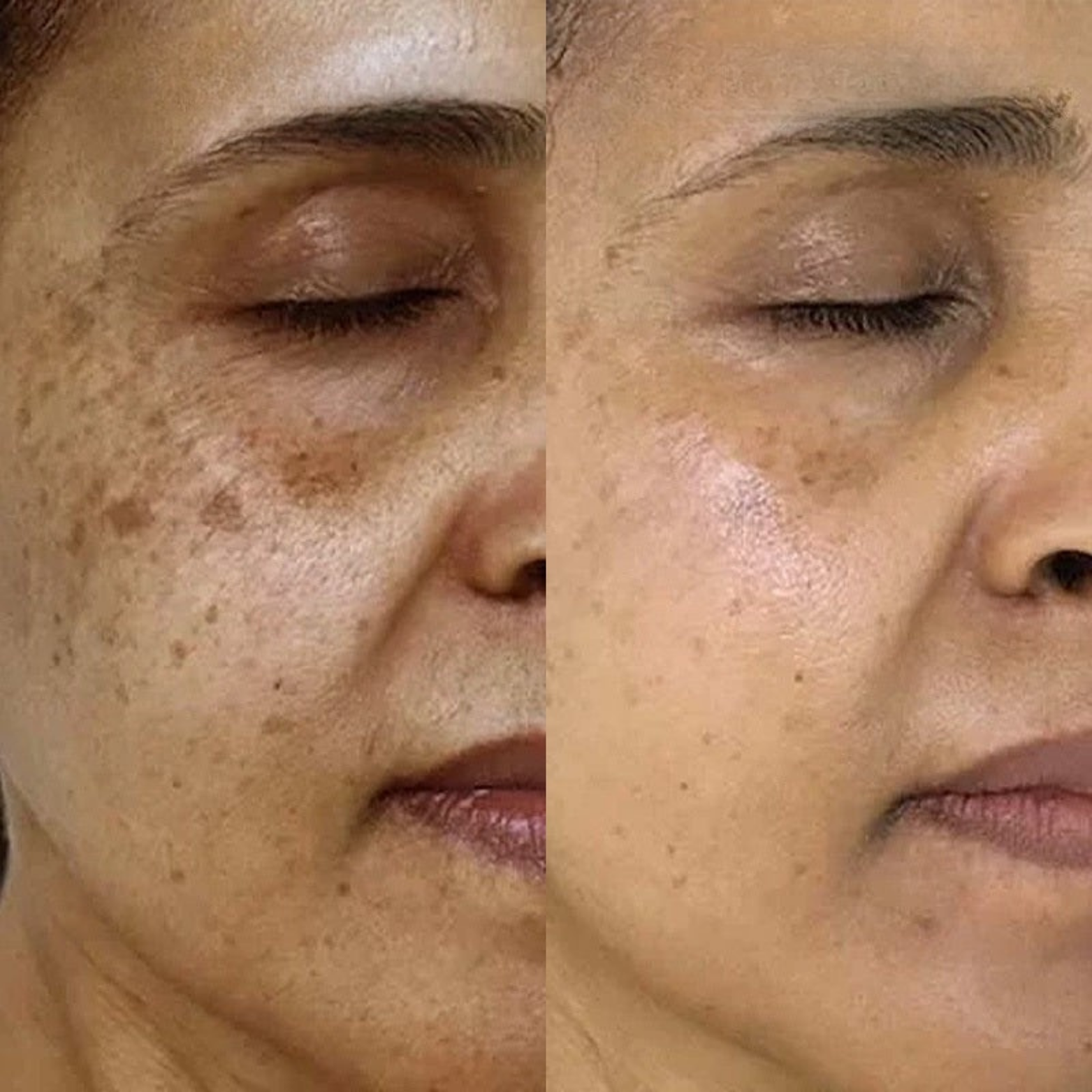 RevitaPen™ Mikroinfusionspenna