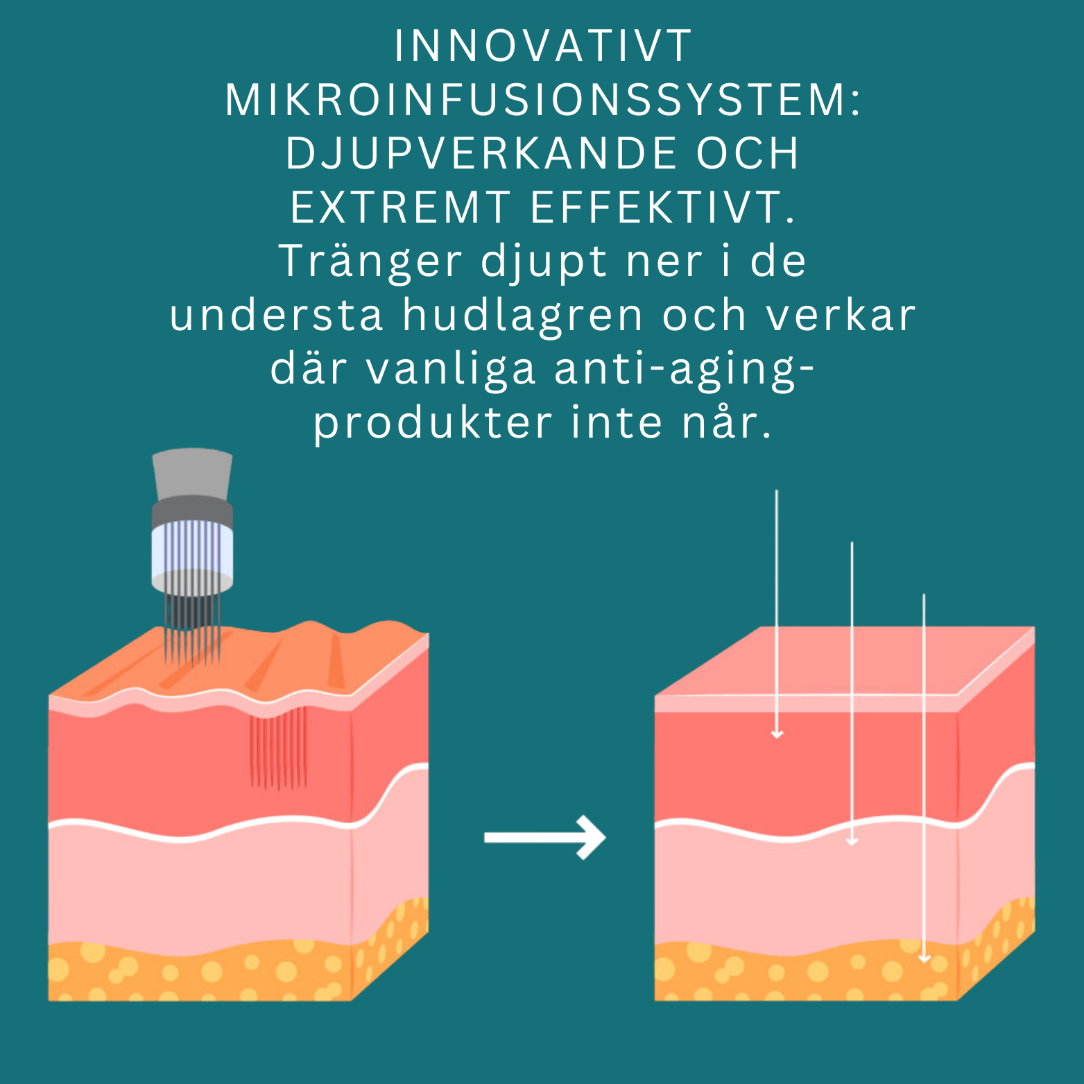 RevitaPen™ Mikroinfusionspenna