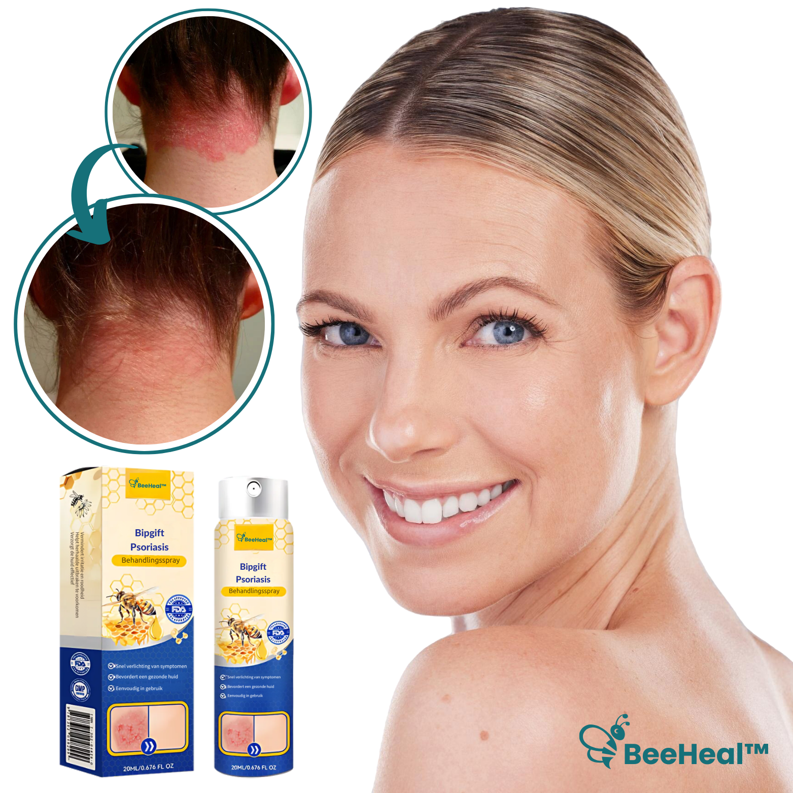 BeeHeal™ Psoriasis & Eksem Spray