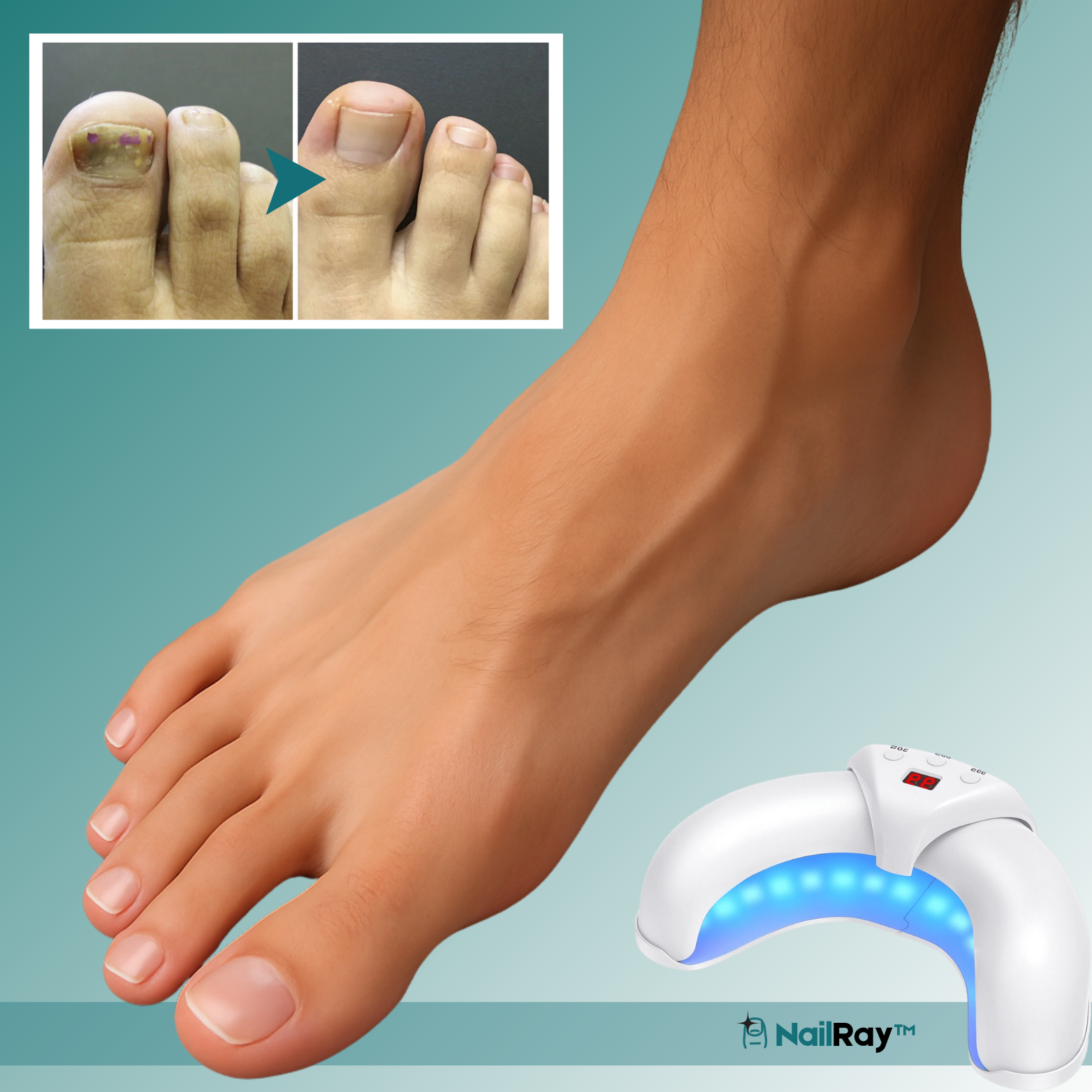NailRay™ Laser Nagelbehandlingsenhet