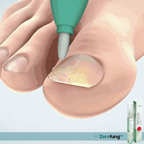 Zerofung™ Nagelreparationspenna