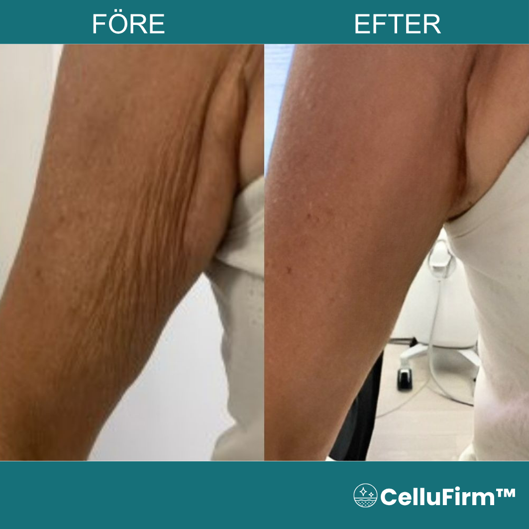 CelluFirm™ Senapssalva