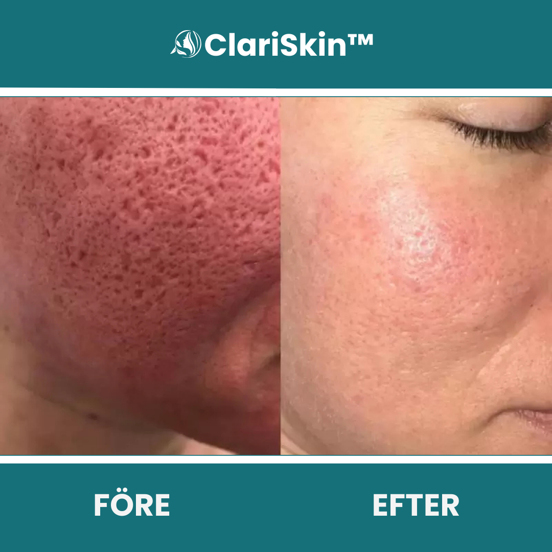 ClariSkin™ SE (3).png__PID:8ab5dd33-fac1-4a71-92c8-b6cc0dfc3b6d