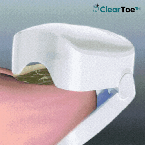 ClearToe™ Avancerad Tånagellaser