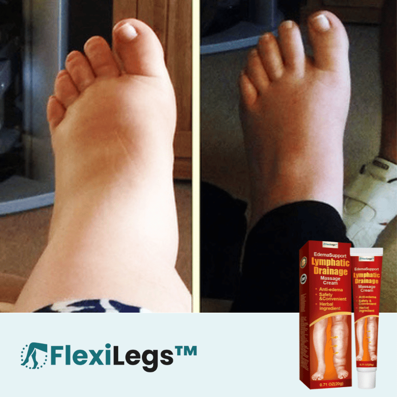FlexiLegs™ Lymfdränagekräm