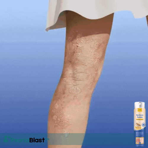 PsoriaBlast™ Bee Venom Psoriasis Spray