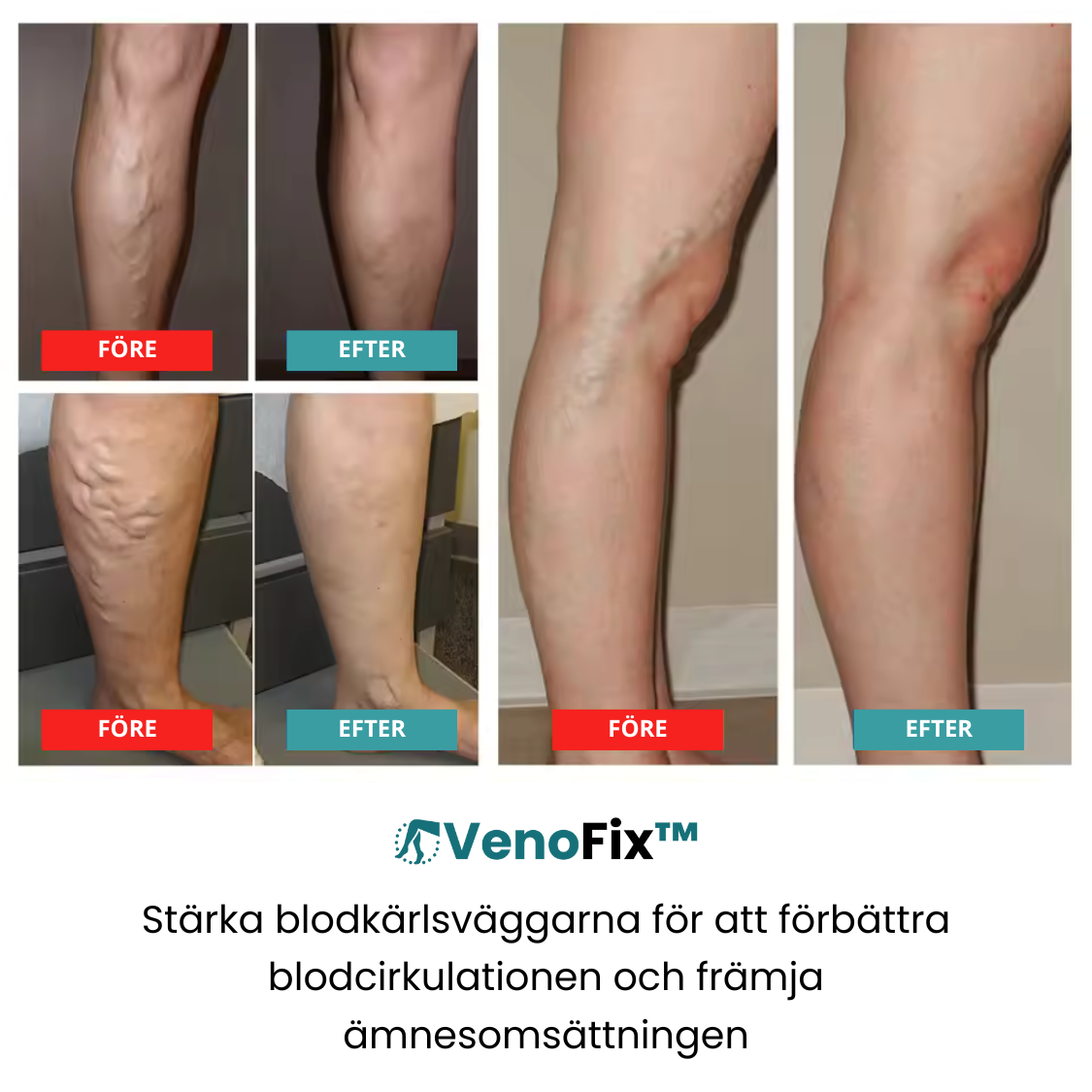 VenoFix™ Åderbråckskräm